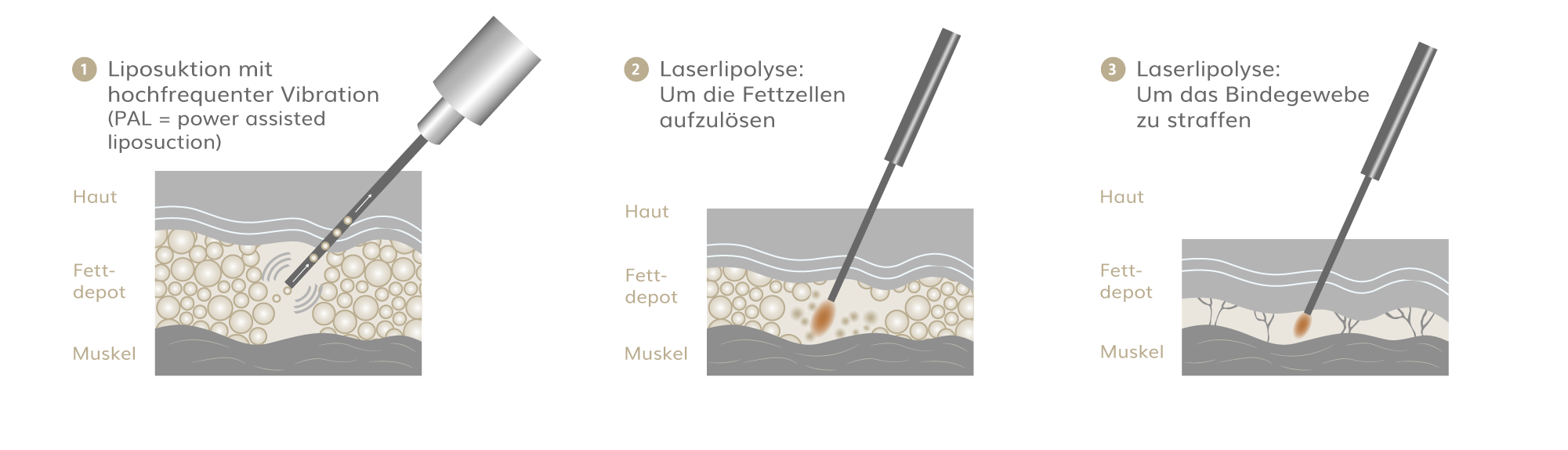 Lipödem OP, Plastische & Ästhetische Chirurgie in Stuttgart, Dr. Schumacher